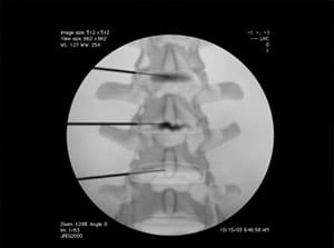 عمل بسته ستون فقرات گردن