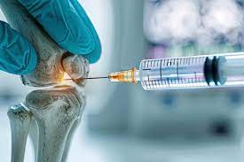 تزریق اوزون در شانه یا هر بخش دیگری از بدن، یک روش درمانی است که به طور فزاینده‌ای در حوزه‌های مختلف پزشکی و زیبایی مورد استفاده قرار می‌گیرد. این روش بر اساس خواص ضدالتهابی، ضدباکتریایی و تقویت‌کننده جریان خون اوزون استوار است. در ادامه به بررسی جنبه‌های مختلف تزریق اوزون در ناحیه شانه می‌پردازیم: 1. کاربردهای تزریق اوزون در شانه تزریق اوزون در شانه معمولاً برای درمان مشکلات زیر استفاده می‌شود: دردهای شانه ناشی از التهابات: مثل بورسیت (التهاب کیسه سینوویال) یا تاندونیت (التهاب تاندون‌ها). آرتروز شانه: تخریب غضروف مفصل شانه که باعث درد و محدودیت حرکتی می‌شود. دردهای عضلانی و تنگی عضلانی: بهبود جریان خون و کاهش تنش عضلانی. اصابت به بافت‌های نرم: آسیب‌های ورزشی یا ضربه‌هایی که منجر به التهاب یا درد موضعی می‌شوند. تسکین دردهای مزمن: اوزون به عنوان یک روش طبیعی برای کاهش درد و التهاب عمل می‌کند. 2. مکانیسم عملکرد اوزون اوزون (O3) یک مولکول فعال اکسیژن است که خواص درمانی متعددی دارد: افزایش اکسیژن‌رسانی: اوزون باعث بهبود جریان خون و افزایش اکسیژن‌رسانی به بافت‌ها می‌شود. کاهش التهاب: اوزون خاصیت ضدالتهابی دارد و می‌تواند التهاب موضعی را کاهش دهد. تحریک ترمیم بافت: اوزون با تحریک تولید فاکتورهای رشد، به ترمیم بافت‌های آسیب‌دیده کمک می‌کند. کاهش درد: اوزون با کاهش فشار در بافت‌ها و بهبود عملکرد عصبی، درد را تسکین می‌دهد. 3. فرآیند تزریق اوزون فرآیند تزریق اوزون در شانه به صورت زیر انجام می‌شود: معاینه و تشخیص: پزشک ابتدا شانه را معاینه کرده و مشکل را تشخیص می‌دهد. آماده‌سازی محل تزریق: محل تزریق با الکل یا مواد ضدعفونی‌کننده تمیز می‌شود. تهیه مخلوط اوزون: اوزون معمولاً با اکسیژن ترکیب شده و به صورت یک مخلوط گازی آماده می‌شود. تزریق اوزون: اوزون با استفاده از یک سرنگ بسیار نازک به داخل بافت‌های مورد نظر (مثل عضلات، تاندون‌ها یا مفاصل) تزریق می‌شود. مراقبت پس از تزریق: ممکن است پزشک توصیه کند که از فشار زیاد یا حرکات شدید در ناحیه شانه خودداری کنید. 4. مزایای تزریق اوزون در شانه بدون نیاز به جراحی: یک روش غیرتهاجمی برای درمان مشکلات شانه. کاهش درد و التهاب: اثرات تسکین‌دهنده اوزون به سرعت احساس می‌شود. بهبود عملکرد شانه: افزایش دامنه حرکتی و کاهش محدودیت‌های حرکتی. کاهش زمان بهبودی: به دلیل تحریک ترمیم بافت، زمان بهبودی کوتاه‌تر است. بدون عوارض جانبی جدی: در صورت انجام توسط متخصص، خطر عوارض بسیار کم است. 5. عوارض احتمالی اگرچه تزریق اوزون معمولاً ایمن است، اما ممکن است عوارض جزئی زیر رخ دهد: قرمزی و تورم موقت: در محل تزریق. احساس سوزش یا خارش: که معمولاً کوتاه‌مدت است. عفونت محل تزریق: در صورت عدم رعایت بهداشت. حساسیت: در موارد بسیار نادر، ممکن است واکنش آلرژیک ایجاد شود. 6. ملاحظات مهم انتخاب پزشک مجرب: تزریق اوزون باید توسط پزشک متخصص یا متخصص فیزیوتراپی با تجربه انجام شود. تعداد جلسات: تعداد جلسات بستگی به نوع مشکل و شدت آن دارد. معمولاً ۳ تا ۶ جلسه تزریق با فواصل زمانی مشخص توصیه می‌شود. همراهی با درمان‌های دیگر: ممکن است تزریق اوزون با فیزیوتراپی یا داروهای ضدالتهابی ترکیب شود. 7. نتیجه‌گیری تزریق اوزون در شانه یک روش درمانی ایمن و مؤثر برای تسکین درد، کاهش التهاب و بهبود عملکرد شانه است. این روش برای افرادی که به دنبال گزینه‌های غیرتهاجمی برای درمان مشکلات شانه هستند، بسیار مناسب است. با این حال، قبل از انجام این درمان، مشاوره با یک پزشک متخصص ضروری است تا اطمینان حاصل شود که این روش برای شما مناسب است. اگر سوال بیشتری دارید یا نیاز به اطلاعات تخصصی‌تر دارید، می‌توانید با یک متخصص طب فیزیکی یا روماتولوژیست مشورت کنید.