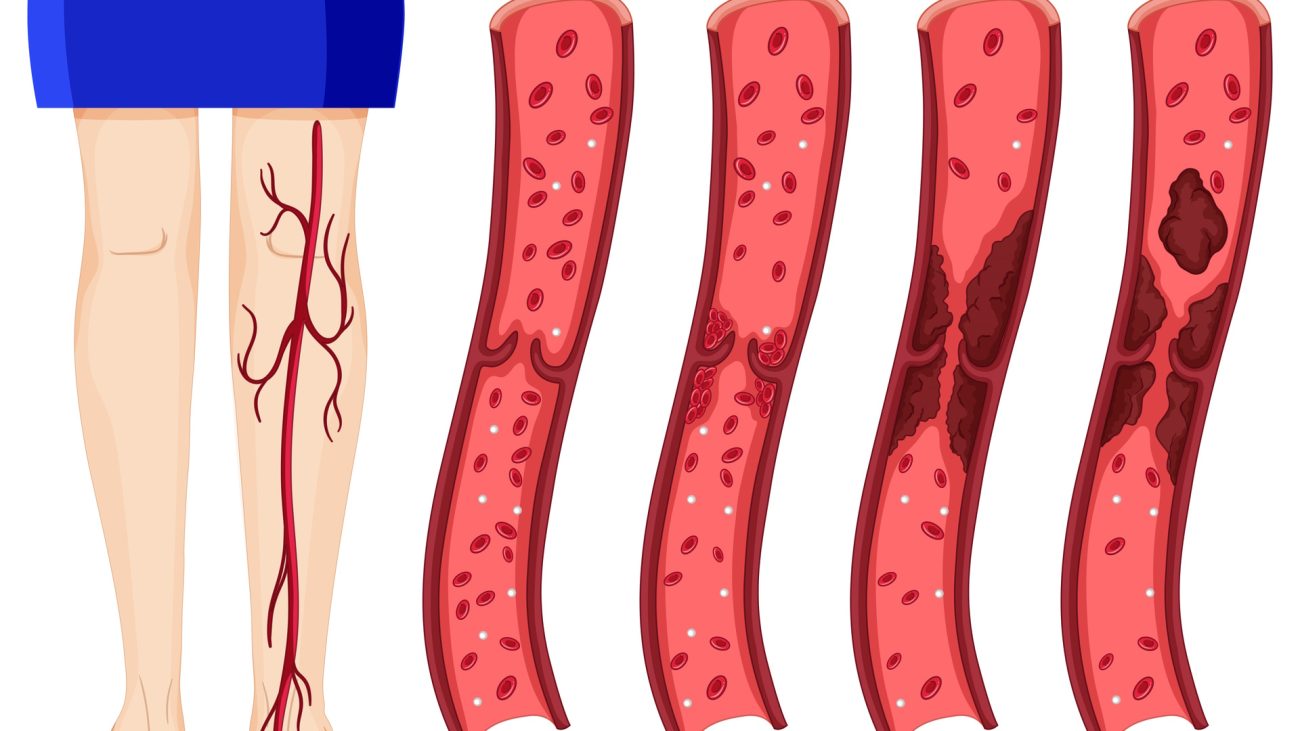 Deep Vein Thrombosis