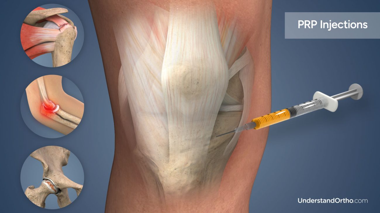 پی آر پی (PRP) چیست؟