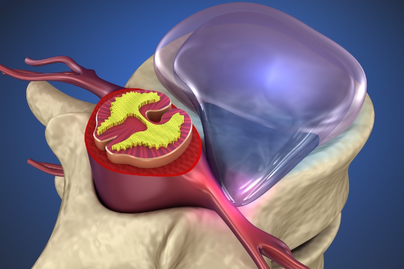 دیسک کمر, دیسک گردن, درمان دیسک بدون جراحی, طب فیزیکی و توانبخشی, ورزش درمانی, اوزون درمانی, طب سوزنی, مانوال تراپی, تزریق ستون فقرات, درمان دستی, درمان درد کمر, درمان درد گردن, متخصص طب فیزیکی